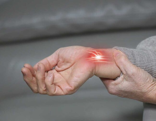 Carpal-Tunnel-Syndrome