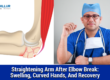 Elbow Fracture
