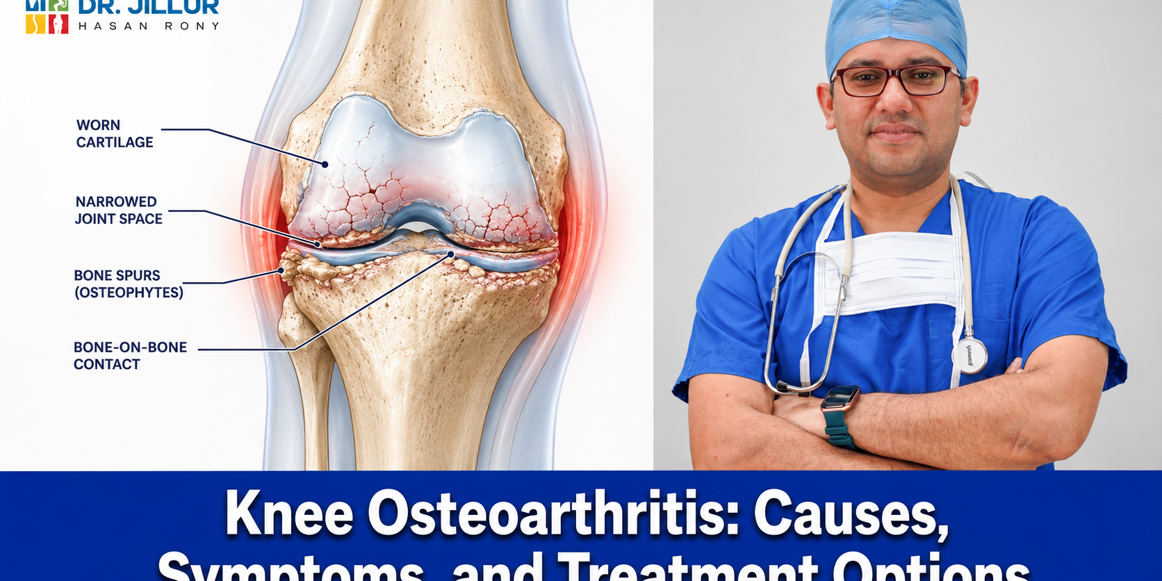 Knee Osteoarthritis: Causes, Symptoms, and Treatment Options